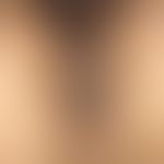 Dyskeratosis follicularis: wenig symptomatische, teils vereinzelte, teils flächenhaft aggregierte...