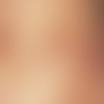 Dyskeratosis follicularis. Papeln und schmutzig-bräunliche Krusten einer zosteriform-striären Dys...