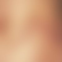 Dyskeratosis follicularis: Papules and dirty-brownish crusts of a zosteriform-striary dyskeratosi...
