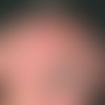 Dyskeratosis follicularis: 74-jährigen Frau. Seit früher Kindheit bestehende, großflächige, am Ka...