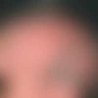 Dyskeratosis follicularis: 74-jährigen Frau. Seit früher Kindheit bestehende, großflächige, am Ka...