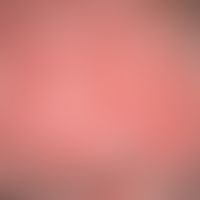Dyskeratosis follicularis. Seit früher Kindheit bestehende, großflächige, hyperkeratotische Zonen...