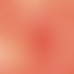 Dyskeratosis follicularis. Auflichtmikroskopie: Ausschnitt aus einer Läsion am Hals. Gelblich-wei...