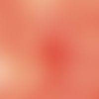 Dyskeratosis follicularis. Auflichtmikroskopie: Ausschnitt aus einer Läsion am Hals. Gelblich-wei...