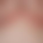 Dyskeratosis follicularis: Darstellung von multiplen, chronisch stationären, intertriginös lokali...