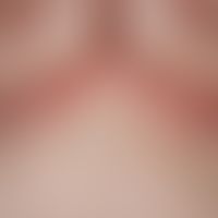 Dyskeratosis follicularis. presentation of multiple, chronically stationary, intertriginously loc...