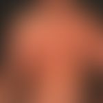 Dyskeratosis follicularis. Übersichtsaufnahme: chronisch dynamische, auf dem Rücken lokalisierte,...