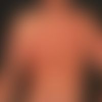 Dyskeratosis follicularis: General view: chronically dynamic, on the back localized, partly disse...