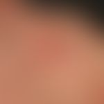 Dyskeratosis follicularis. In der Kindheit erstmals manifestierte, chronisch dynamische, teils lo...