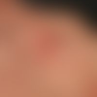 Dyskeratosis follicularis. chronic dynamic, partly loosely disseminated, partly grouped standing,...
