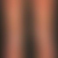 Dyskeratosis follicularis. Übersichtsaufnahme: Multiple, chronisch dynamische, intertriginös loka...