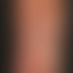 Dyskeratosis follicularis. Detailaufnahme: Gut zu erkennen ist in diesem Bild der verruköse und m...