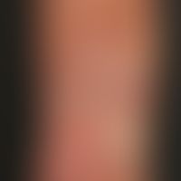 Dyskeratosis follicularis. Detailaufnahme: Gut zu erkennen ist in diesem Bild der verruköse und m...