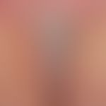 Dyskeratosis follicularis. Befall der Rima ani.&nbsp;Chronische, intertriginöse,&nbsp;weißlich ve...