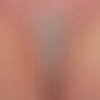 Dyskeratosis follicularis. Befall der Rima ani.&nbsp;Chronische, intertriginöse,&nbsp;weißlich ve...