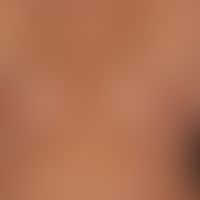 Dyskeratosis follicularis (Darier's disease): non-itching, chronically persistent, disseminated p...
