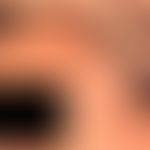 Dyskeratosis follicularis (Morbus Darier) Disseminierte, gelb-bräunliche Papeln und Plaques, stel...