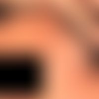 Dyskeratosis follicularis (Morbus Darier) Disseminierte, gelb-bräunliche Papeln und Plaques, stel...