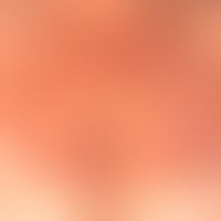 Dyskeratosis follicularis (Morbus Darier):&nbsp;Akute Provokation der Erkrankung nach leichter De...