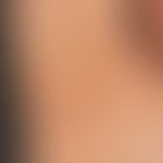 Dyskeratosis follicularis (Morbus Darier). Etwa 0,3-0,4 cm große, disseminierte, gelb-braune weni...