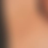Dyskeratosis follicularis (Morbus Darier). Etwa 0,3-0,4 cm große, disseminierte, gelb-braune weni...