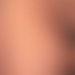 Dyskeratosis follicularis (Morbus Darier). Disseminierte rote&nbsp; bis rot-braune Papeln und Pla...