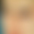 Dysplasie, anhidrotische ektodermale. Ichthyosiforme Hautveränderungen im Gesicht, Fehlen der Haa...