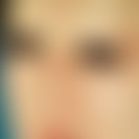Dysplasie, anhidrotische ektodermale. Ichthyosiforme Hautveränderungen im Gesicht, Fehlen der Haa...