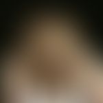 Dysplasie, ektodermale. Seit frühestem Kindesalter spärliches Haarwachstum bei einem 4-jährigen J...