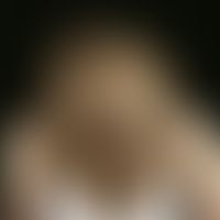 dysplasia, ectodermal. since earliest childhood sparse hair growth in a 4-year-old boy. already s...