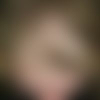 Dysplasia, ectodermal. Since earliest childhood sparse hair growth in a 3-year-old girl. Already ...