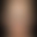Dysplasia, hidrotic ectodermal. 2-year-old boy with thin, fragile, short, dry hair. Noticeable is...
