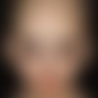 Dysplasie, hidrotische ektodermale. 2 Jahre alter Junge mit dünnen, brüchigen, kurzen, trockenen ...