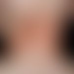 Dysplasie, hidrotische ektodermale. Hyperkeratosen auf dem Nacken eines 2 Jahre alten Jungen. Neb...