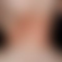 Dysplasie, hidrotische ektodermale. Hyperkeratosen auf dem Nacken eines 2 Jahre alten Jungen. Neb...