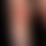 Dysplasie, hidrotische ektodermale. Umschriebene, polsterartige, fibrotische Verdickungen an den ...