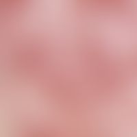 Eccema herpeticatum. Dicht aggregierte, gruppiert stehende, zentral genabelte Bläschen und erodie...