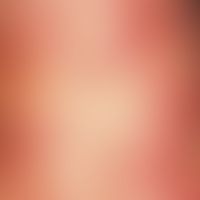Eccema herpeticatum. Gruppierte, teilweise genabelte Papeln und Bläschen am Hals eines 10-jährige...