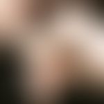 Ehlers-Danlos-Syndrom:&nbsp;Überstreckbarkeit der Gelenke im Bereich der Hände.
