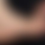 Ehlers Danlos Syndrom, Überstreckbarkeit der Gelenke.
