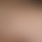 Ehlers-Danlos-Syndrom:&nbsp;Anetodermie-artige Narben.
