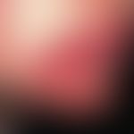 Ecchymosis. circumscribed purple-shaped hemorrhage on the chin of a 14-year-old boy. the lesion i...
