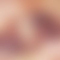 ecchymosis syndrome, painful, intermittent manifestation of painful skin bleeding in a 48-year-ol...