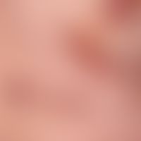 Ecchymosis syndrome, painful. 4 weeks ago for the first time occurred painful, extensive ecchymos...