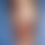 Ekthyma:&nbsp;multiple, akute, an beiden Unterschenkeln disseminierte, 0,4-1,0 cm große, schmerzh...