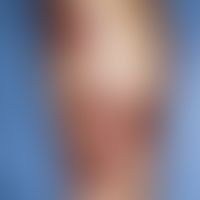 Ekthyma:&nbsp;multiple, akute, an beiden Unterschenkeln disseminierte, 0,4-1,0 cm große, schmerzh...