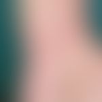 eczema, atopic. multiple, chronically dynamic, blurred, sometimes itchy, red, rough plaques. know...