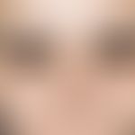 Eczema, atopic. isolated eyelid infestation with brownish discoloration, Dennie Morgan infraorbit...