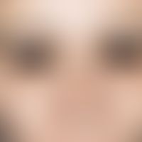 Dermatitis, atopische:&nbsp;isolierter Lidbefall (mäßiger Juckreiz) mit bräunlicher Verfärbung, D...