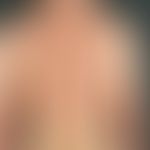 Generalized atopic eczema: Exacerbated, generalized seizure-like itchy dermatitis with multiple, ...